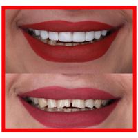کامپوزیت دندان/لمینیت/دندانپزشکی/ترمیم/پالیش|خدمات آرایشگری و زیبایی|تهران, جردن|دیوار