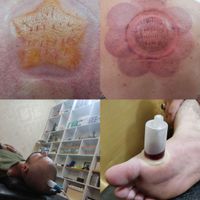 دیسک کمر سیاتیک فیزیوتراپی بادکش زالو درمانی حجامت|خدمات آرایشگری و زیبایی|تهران, پلیس|دیوار