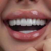 کامپوزیت دندان،لمینیت،روکش،عصب کشی|خدمات آرایشگری و زیبایی|تهران, شهرک غرب|دیوار