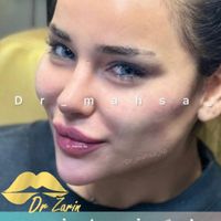 دکتر زرین لیپ ، فیلر لب روسی زاویه فک گونه چانه ژل|خدمات آرایشگری و زیبایی|تهران, پونک|دیوار