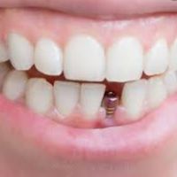خدمات ایمپلنت و دندان مصنوعی اقساط|خدمات آرایشگری و زیبایی|تهران, فدک|دیوار