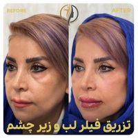 جشنواره ژل بوتاکس لیزر سعادت آباد|خدمات آرایشگری و زیبایی|تهران, سعادت‌آباد|دیوار