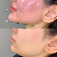 مدل ژل لب روسی نخ انزیم فیلر بوتاکس زاویه فیلربادی|خدمات آرایشگری و زیبایی|تهران, تهرانپارس غربی|دیوار