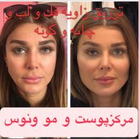 تزریق ژل لب روسی بوتاکس چشم گربه ای،لیفت،لیزر|خدمات آرایشگری و زیبایی|تهران, صادقیه|دیوار