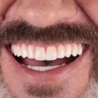 ایمپلنت درجه یک/اقساطی/بدون پیش پرداخت /تخفیف|خدمات آرایشگری و زیبایی|تهران, شهرک غرب|دیوار