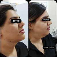 ‌ی پاییزه فیلر/بوتاکس/مزو/prp/ساکشن غبغب|خدمات آرایشگری و زیبایی|تهران, دروازه شمیران|دیوار