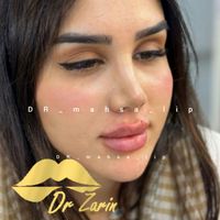 دکتر زرین لیپ ، فیلر لب روسی زاویه فک گونه چانه ژل|خدمات آرایشگری و زیبایی|تهران, پونک|دیوار