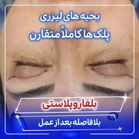 بلفاروپلاستی توسط جراح و متخصص چشم|خدمات آرایشگری و زیبایی|تهران, صادقیه|دیوار