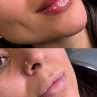 تزریق لب روسی/فیلر بادی/بوتاکس/مزوژل/prp|خدمات آرایشگری و زیبایی|تهران, تهرانپارس غربی|دیوار