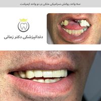 ایمپلنت و لمینیت دیجیتال با شرایط پرداخت|خدمات آرایشگری و زیبایی|تهران, امیریه|دیوار