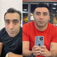 کاشت مو تبریز|خدمات آرایشگری و زیبایی|مرند, |دیوار