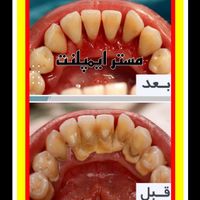 مستر ایمپلنت و ونیر کامپوزیت توسط پزشک|خدمات آرایشگری و زیبایی|تهران, تهران‌سر|دیوار