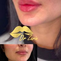 دکتر زرین لیپ ، فیلر لب روسی زاویه فک گونه چانه ژل|خدمات آرایشگری و زیبایی|تهران, پونک|دیوار