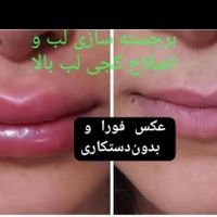 تزریق مدل توسط پزشک مدرس ژل بوتاکس لیزر نخ پی آرپی|خدمات آرایشگری و زیبایی|تهران, تهران‌سر|دیوار