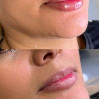 تزریق لب روسی/فیلر بادی/بوتاکس/مزوژل/prp|خدمات آرایشگری و زیبایی|تهران, تهرانپارس غربی|دیوار