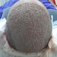 جشنواره کاشت مو ، ریش ، ابرو|خدمات آرایشگری و زیبایی|شیراز, بعثت|دیوار