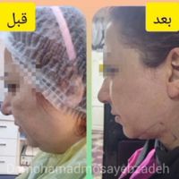 جشنواره ساکشن غبغب 4800 محدوده هروی|خدمات آرایشگری و زیبایی|تهران, هروی|دیوار