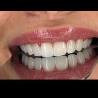 مدل کامپوزیت ونیر فرصت استثنایی به مدت یک هفته|خدمات آرایشگری و زیبایی|تهران, نواب|دیوار