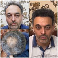 کاشت موباخط رویش طبیعی وبالاترین تراکم|خدمات آرایشگری و زیبایی|تهران, عباس‌آباد|دیوار