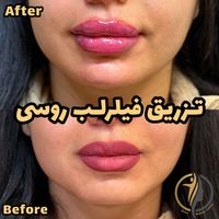 فیلر لب زاویه سازی صورت بوتاکس فیلر زیرچشم|خدمات آرایشگری و زیبایی|تهران, سعادت‌آباد|دیوار