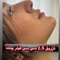 تزریق ژل و بوتاکس انزیم و مزو|خدمات آرایشگری و زیبایی|تهران, عبدل‌آباد|دیوار