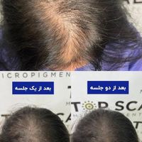 تکنیک جدید جایگزین کاشتمو میکرو اسکالپ|خدمات آرایشگری و زیبایی|تهران, تهرانپارس غربی|دیوار