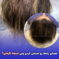 تکنیک جدید جایگزین کاشتمو میکرو اسکالپ|خدمات آرایشگری و زیبایی|تهران, تهرانپارس غربی|دیوار