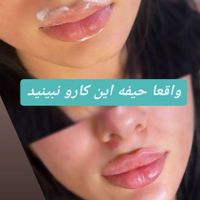 ژل لب،بوتاکس، جراحی پلک وبینی،مزوژل،لیفت صورت|خدمات آرایشگری و زیبایی|تهران, هروی|دیوار