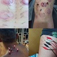 دیسک کمر سیاتیک فیزیوتراپی بادکش زالو درمانی حجامت|خدمات آرایشگری و زیبایی|تهران, پلیس|دیوار