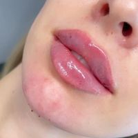 تزریق ژل و بوتاکس وپاک کردن تتو بالیزر و لیزربدن|خدمات آرایشگری و زیبایی|تهران, هفت حوض|دیوار