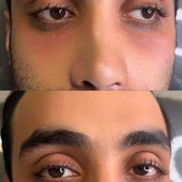 تزریق لب روسی/فیلر بادی/بوتاکس/مزوژل/prp|خدمات آرایشگری و زیبایی|تهران, تهرانپارس غربی|دیوار
