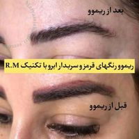 ریموو تخصصی تاتو صورت و بدن|خدمات آرایشگری و زیبایی|تهران, باغ فیض|دیوار