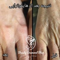 کلینیک تخصصی هایفوتراپی و انواع تزریق|خدمات آرایشگری و زیبایی|تهران, الهیه|دیوار