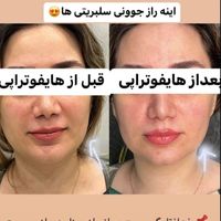 هایفو تراپی و زاویه سازی فک|خدمات آرایشگری و زیبایی|تهران, قبا|دیوار