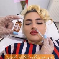 جشنواره تزریق ژل و بوتاکس ، افر ویژه ۴۰ درصدی|خدمات آرایشگری و زیبایی|تهران, پیروزی|دیوار