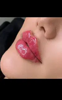 فروش فیلر نورامیس