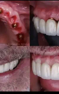 جشنواره تابستانی دندان پزشکی و ایمپلنت