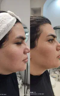 هایفو ۵۲ بعدی زاویه‌سازی فک و لیفت صورت بدون درد