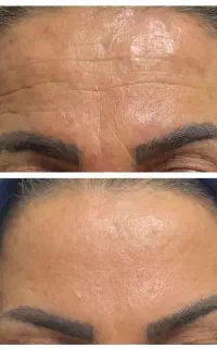 کرم ضد چروک و جوش