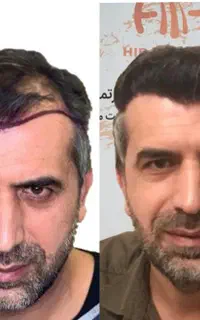 جشنواره ویژه کاشت مو.ابرو.ریش کیلنیک تخصصی فقط ۲۰