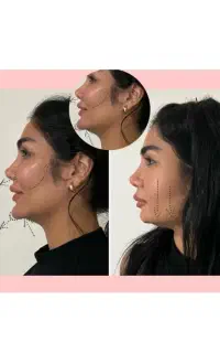 خدمات ژل بوتاکس مزو آنزیم توسط پزشک مجرب
