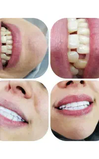 کامپوزیت دندان فکی ۳۰میلیون و لمینت فکی ۹۹ میلیون