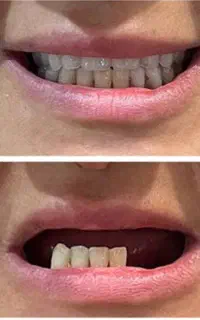 ساخت  ساخت دندان متحرک با قیمتی باورنکردنی