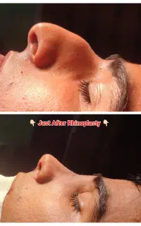 رینو ‌پلاستی (جراحی زیبایی بینی با کمترین قیمت)