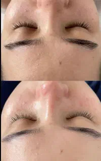 آموزش فشیال و اسکالپ سر