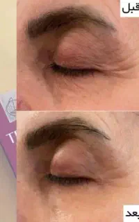 خداحافظی با تیرگی و چروک دور چشم