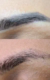 لیزر ریمو تتو بدن ، ابرو ، خط چشم ، خط لب