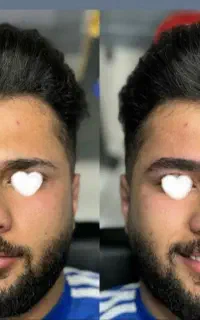میکروبلیدینگ آقایان. رفع کم پشتی ابرو