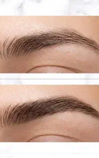 ریموو تتو حرفه ای با قیمت مناسب به مدت محدود