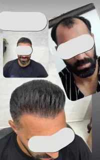 کاشت مو طبیعی و میکرو کاشت ابرو
